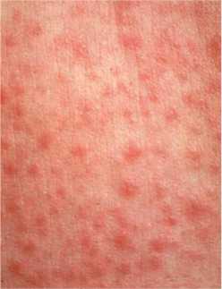 Measles spots